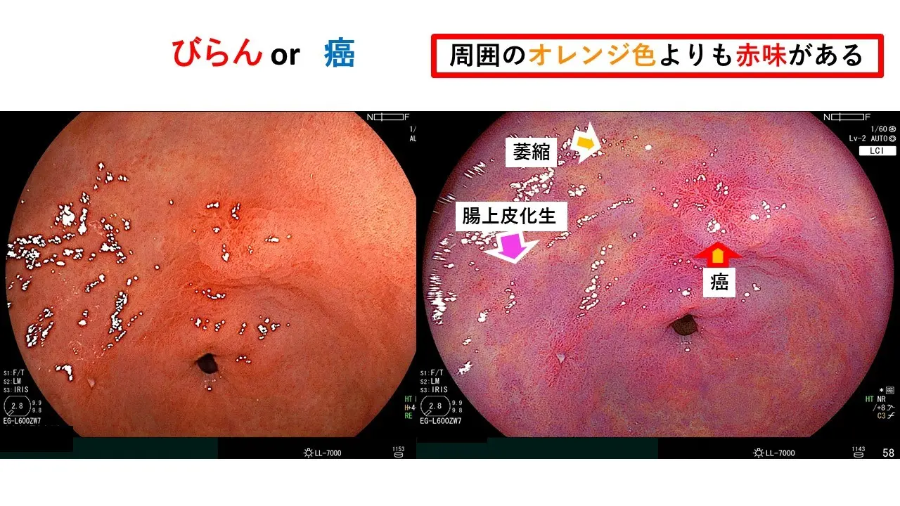 幽門部付近におけるビランと癌の鑑別