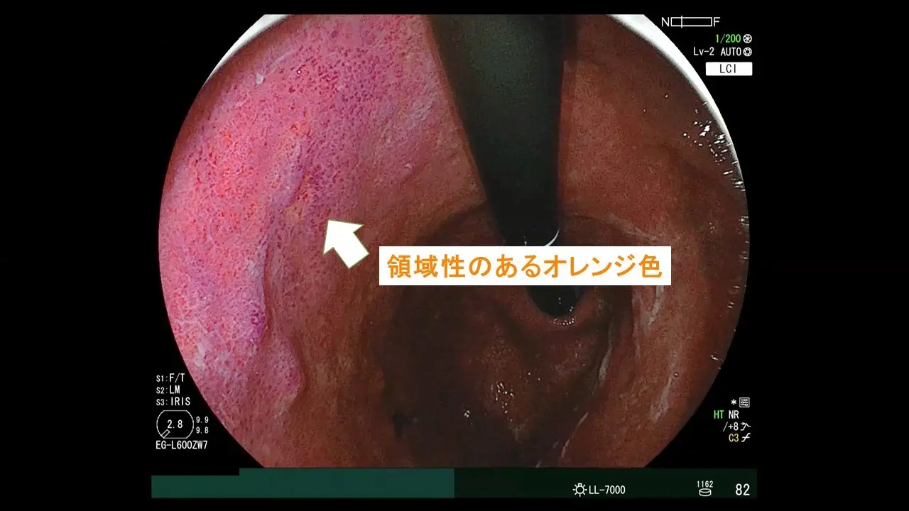 LCIがきっかけで発見できた未分化がん