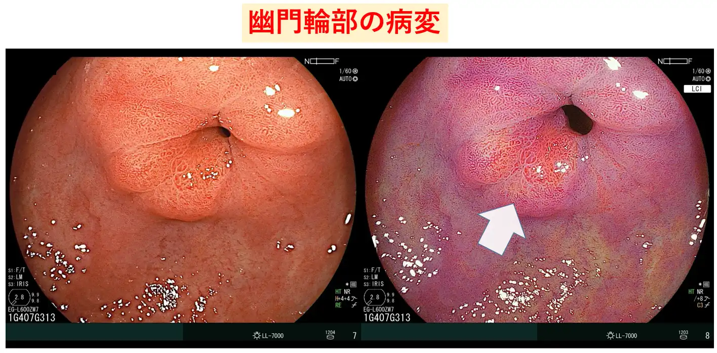 幽門輪部も色彩強調で可視化