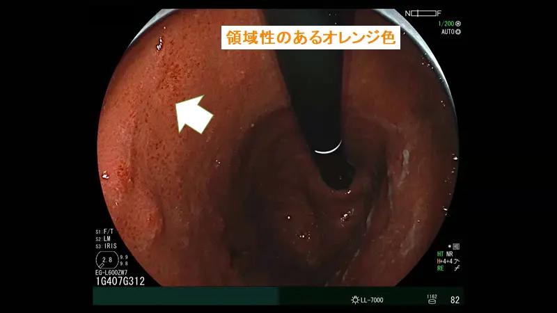 LCIがきっかけで発見できた未分化がん