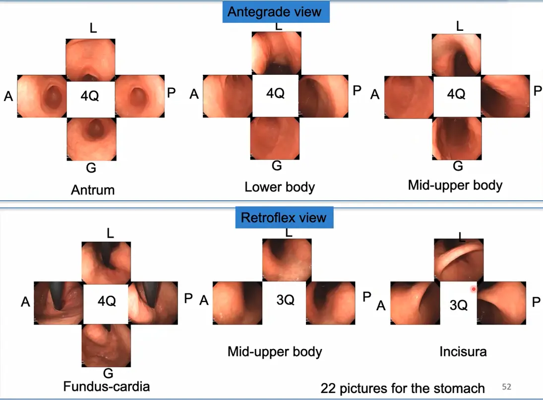 （図2）e-Learning Systemにおける、胃内の観察漏れを防ぐために 胃内を22部位に分けて観察する方法を説明した図