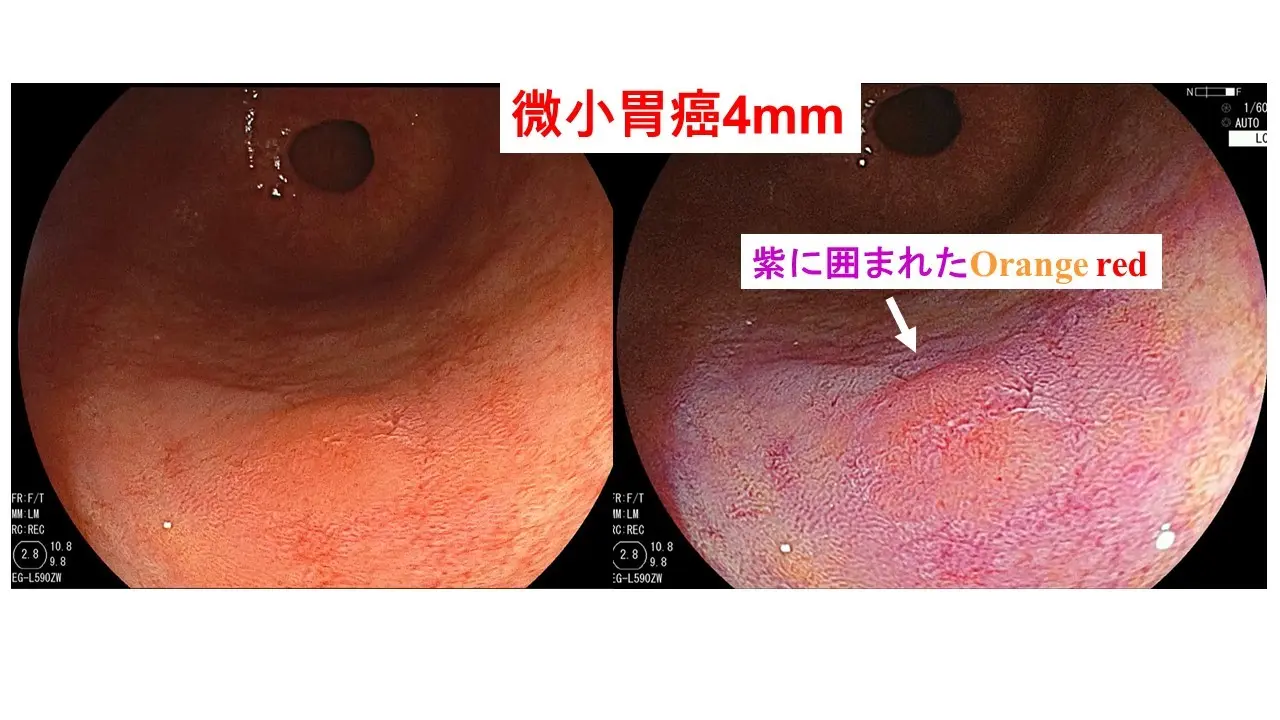 微小胃癌の鑑別でもLCIが役立つ