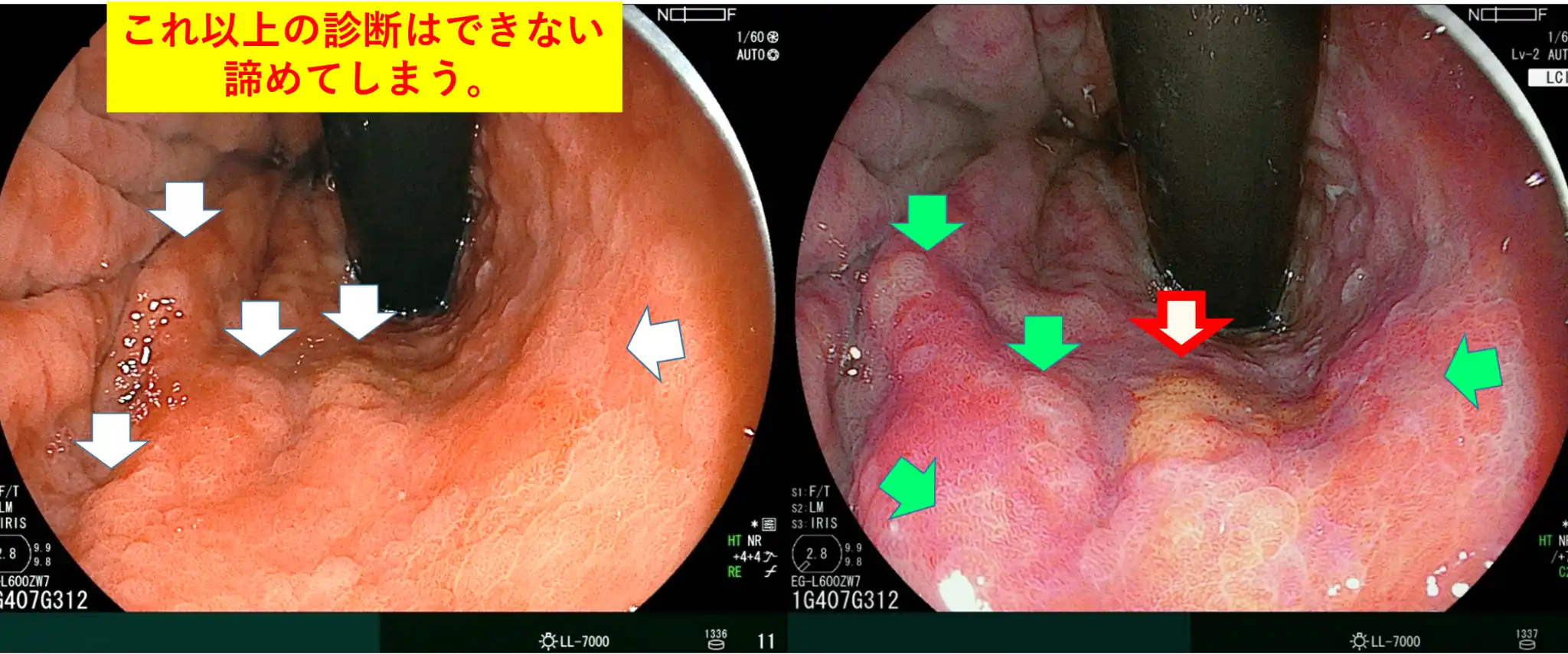 色彩強調はがんと炎症性病変の鑑別に自信を与える