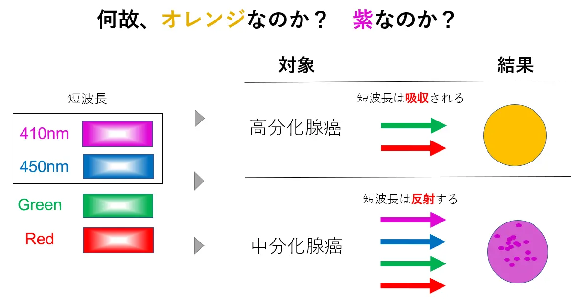 LCIでは色で病変を見分ける