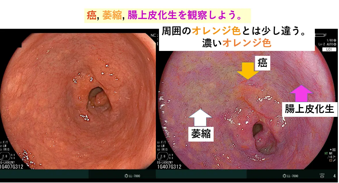 LCIでの観察におけるポイント