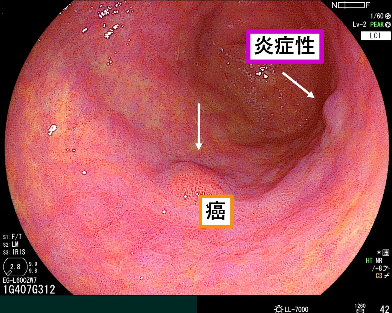 病変の特徴よりも視認性があるLCI