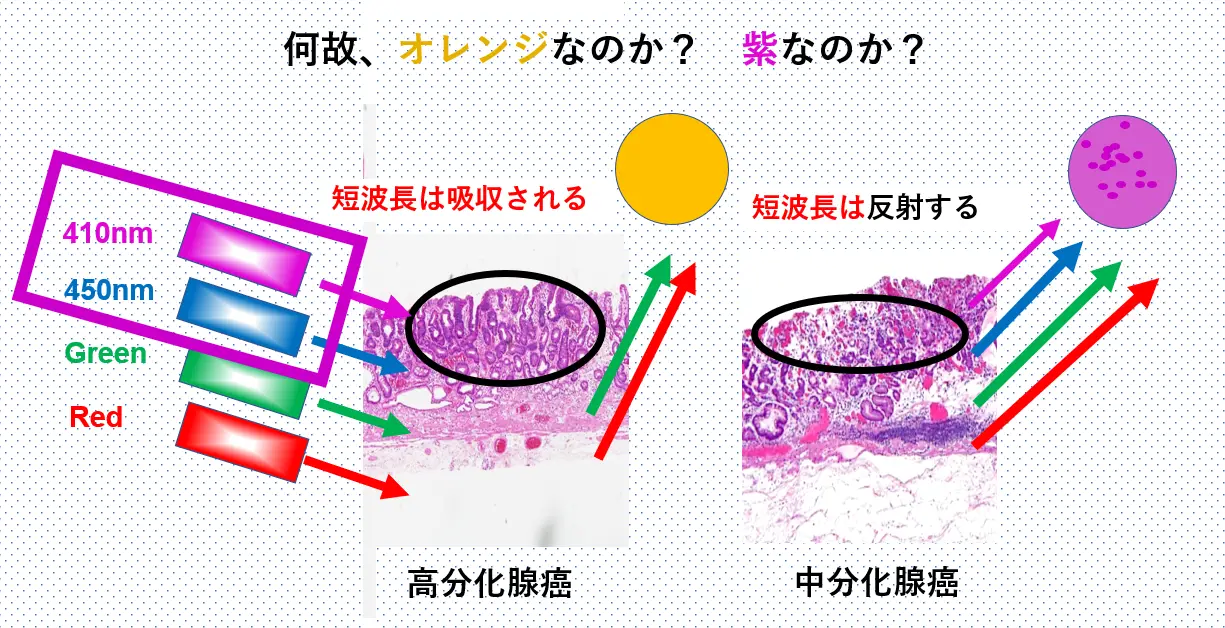 なぜ、LCIでは色調がオレンジ色と紫色に分かれるのか？