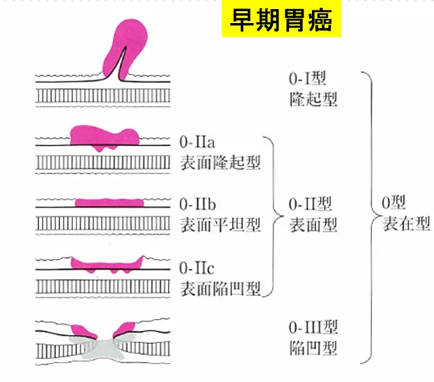 胃がんの肉眼形態分類