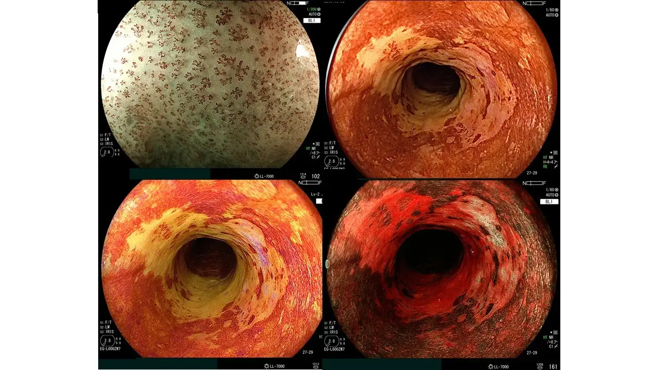 食道がんの観察におけるLCIの可能性