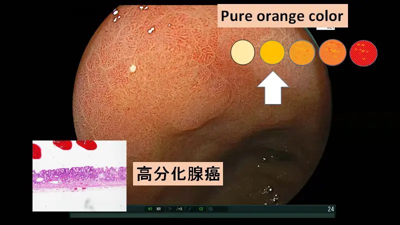 オレンジ領域の診断能力を高める