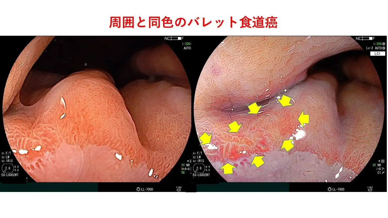 食道がんの観察におけるLCIの可能性