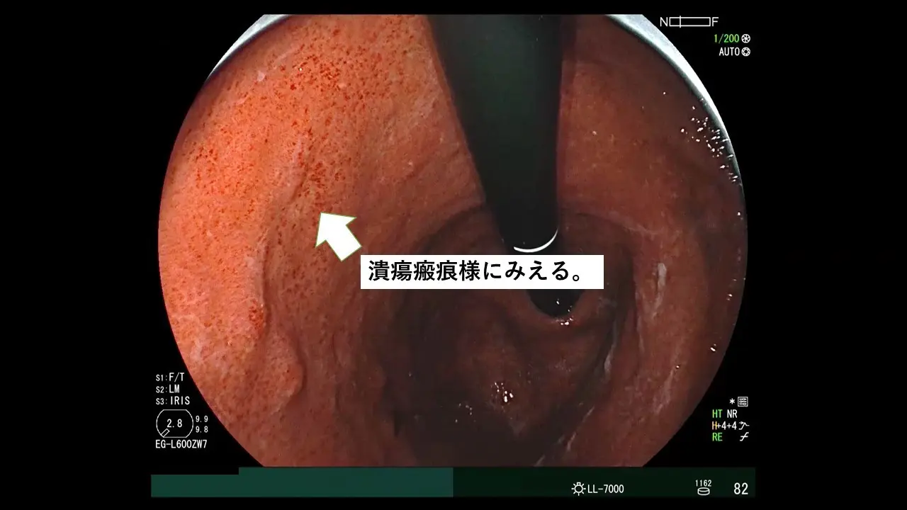 LCIがきっかけで発見できた未分化がん