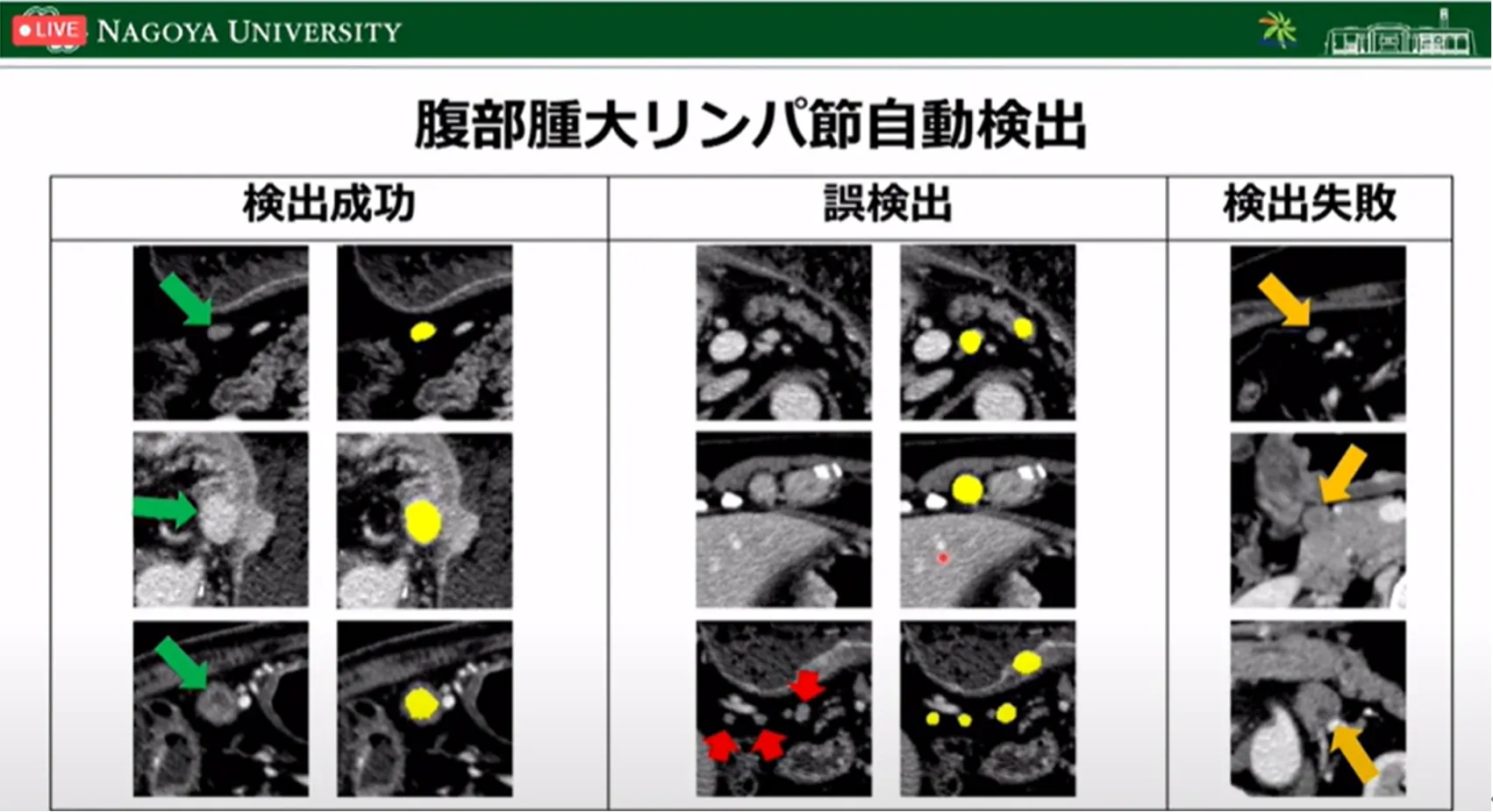 胃がん診断・治療のすべての段階でAI利活用の可能性を探る！名古屋大学大学院・森健策教授による最新研究の紹介（第94回日本胃癌学会総会）